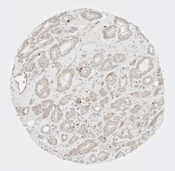 IHC of prostate cancer labeled with DSHB antibody CPTC-ADA-1 against Adenosine Deaminase Peptide 1. Image Credit: NCI-Clinical Proteomic Technologies for Cancer.